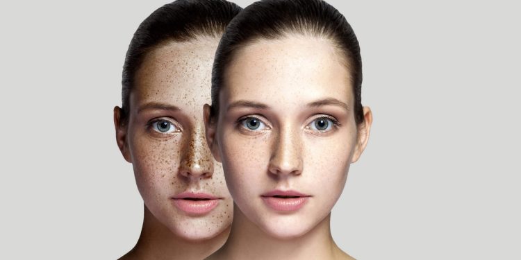 Battling Post-Summer Dark Spots?