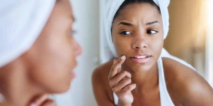 Summer Breakouts Can Happen—Here’s How to Treat and Prevent Them