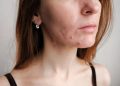 Hormonal vs. Bacterial Acne: Here’s How to Tell Which Type You Have