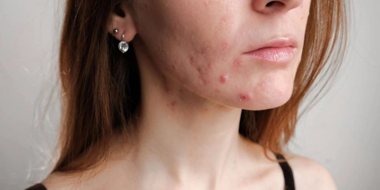 Hormonal vs. Bacterial Acne: Here’s How to Tell Which Type You Have