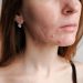 Hormonal vs. Bacterial Acne: Here’s How to Tell Which Type You Have