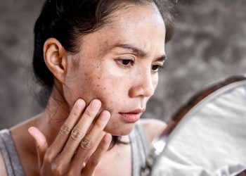 Hyperpigmentation 101: The Key Causes and Treatments