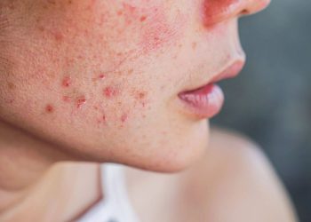 Summer Acne SOS – Banish Breakouts