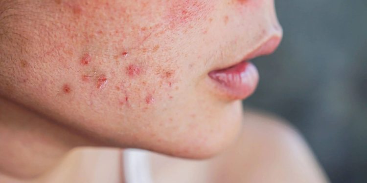 Summer Acne SOS – Banish Breakouts