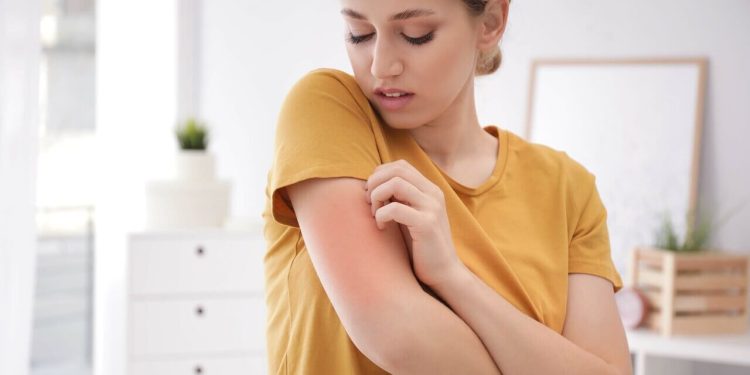 10 Clean Ingredients That Help Eczema Sufferers
