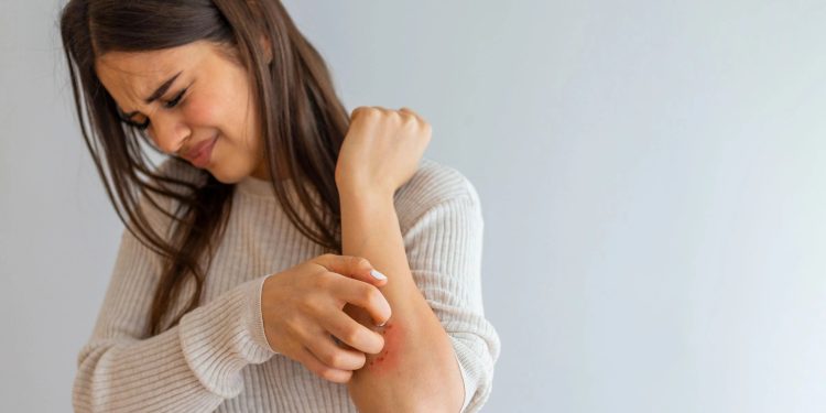 Eczema Essentials: A Comprehensive Guide to Causes and Treatments