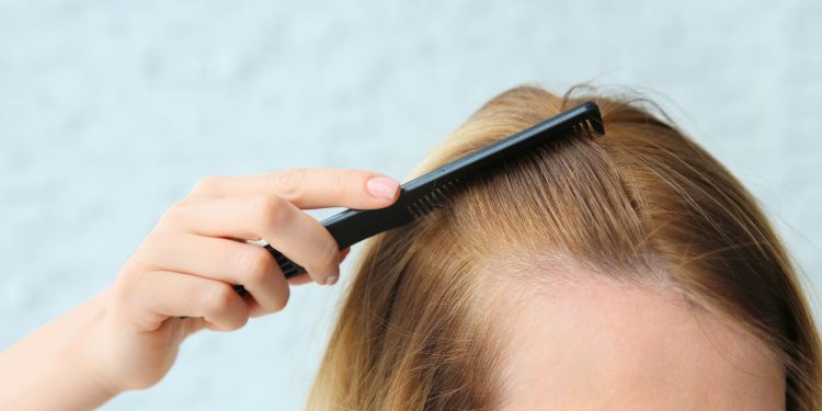 Rosemary vs. Minoxidil: Natural Hair Loss Solutions