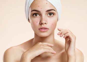 Acne Treatment Basics: Salicin Vs. Salicylic Acid