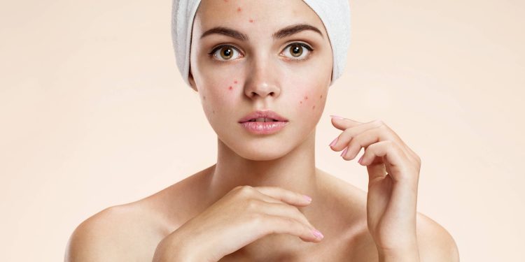 Acne Treatment Basics: Salicin Vs. Salicylic Acid