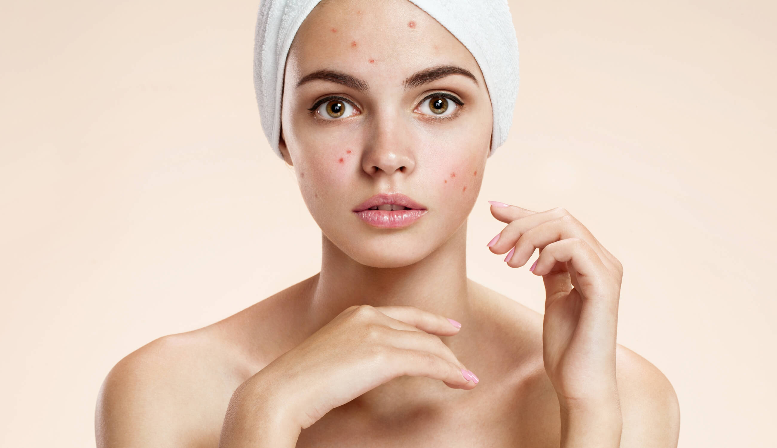 Woman with acne