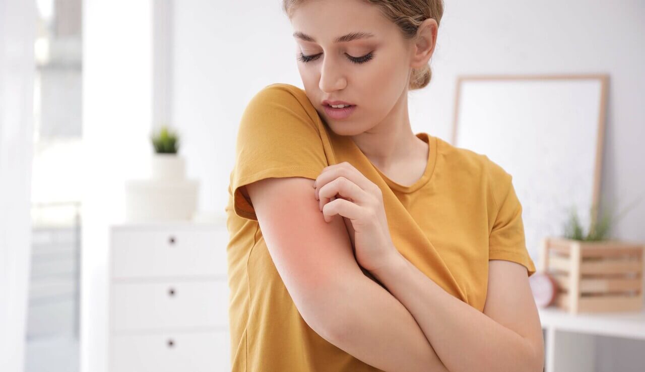 Woman with eczema rash on her arm