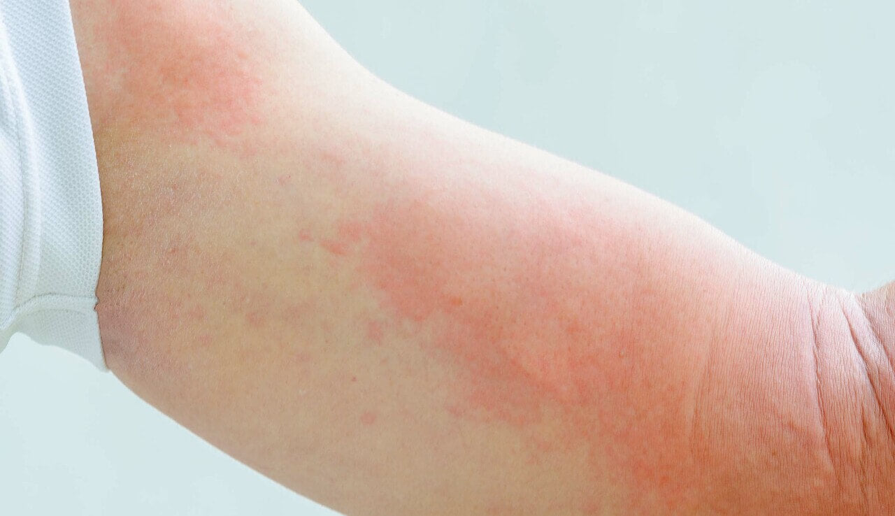 Eczema flare up on arm