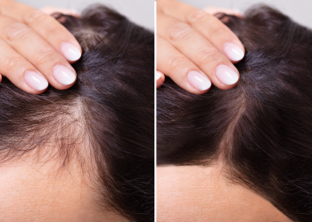 Natural Solutions for Hair Loss: Your Complete Guide to Regrowth