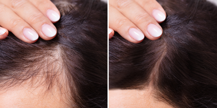 Natural Solutions for Hair Loss: Your Complete Guide to Regrowth