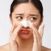 Blackhead Removal That Doesn’t Damage Your Skin